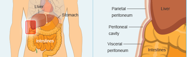 peritoneal mesothelioma  wikitechy