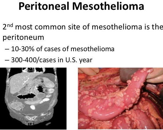 What Are The Symptoms Of Peritoneal Mesothelioma
