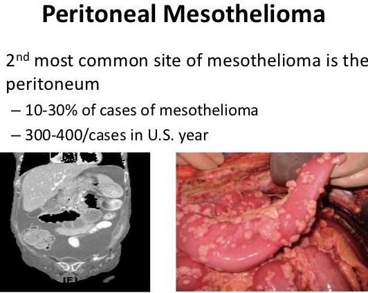 treatment for squamous cell skin cancer in situ