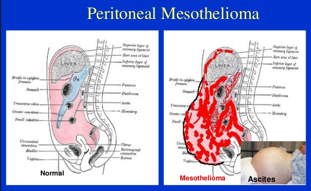 Peritoneal cancer abdominal pain